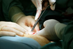 Пересадка поджелудочной железы - пример на фото 3